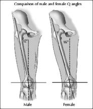 Risk Factor: Anatomy Increased femoral anteversion Excessive tibial torsion Increased Q angle