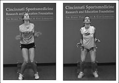 ACL Prevention Programs Skiing, basketball, soccer 60-89% reduction in severe ACL injuries Accelerated round turn Multi-step stop for deceleration Emphasize flexed hip over knee over ankle landings