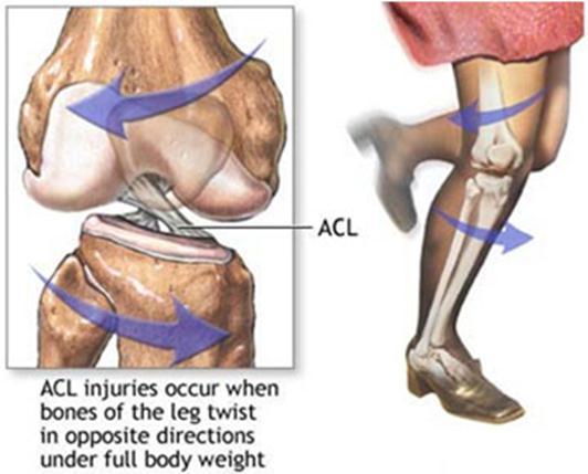 ACL Injury 250,000 pa in US (Griffin et al, 2006) > 70% cases non contact mechanism (Hernandez 2006) Decreased activity level (Arden, et al, 2014) Poor reported Q of L (Spindler, 2008) Irrespective
