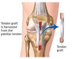 ACL Reconstruction Restores kinematics of the tibiofemoral joint Reduce risk