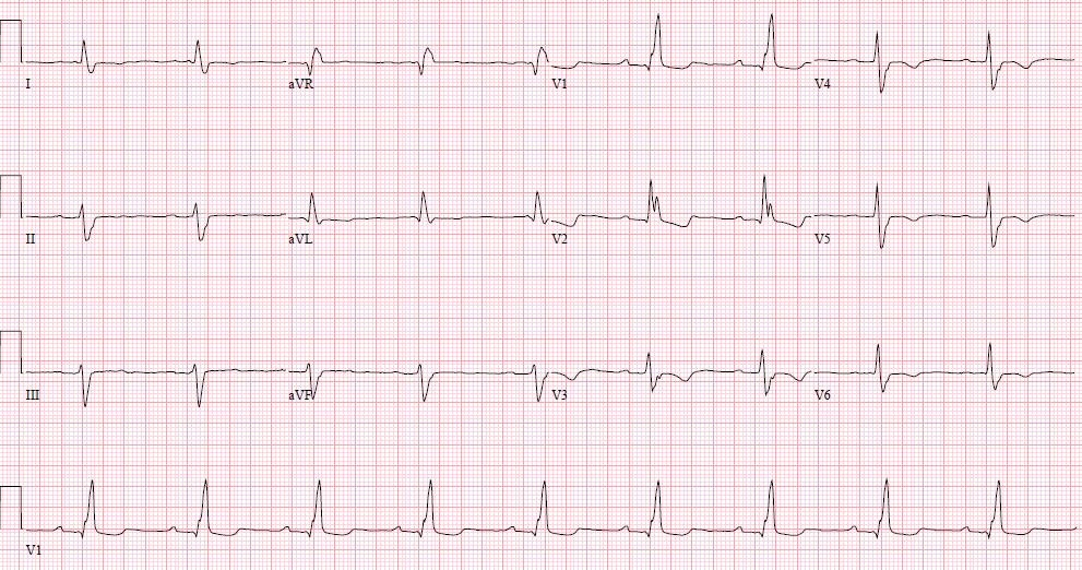 20-January-2012 Things to note: 1) wide QRS (~160 ms) with late rightward (red) and anterior (blue) forces: i.e., RBBB 2) LAD (-70 ) with S III > S II ; i.e., a marker of left anterior fascicular block 3) Small q in V1-2 plus anterior T wave inversion: i.