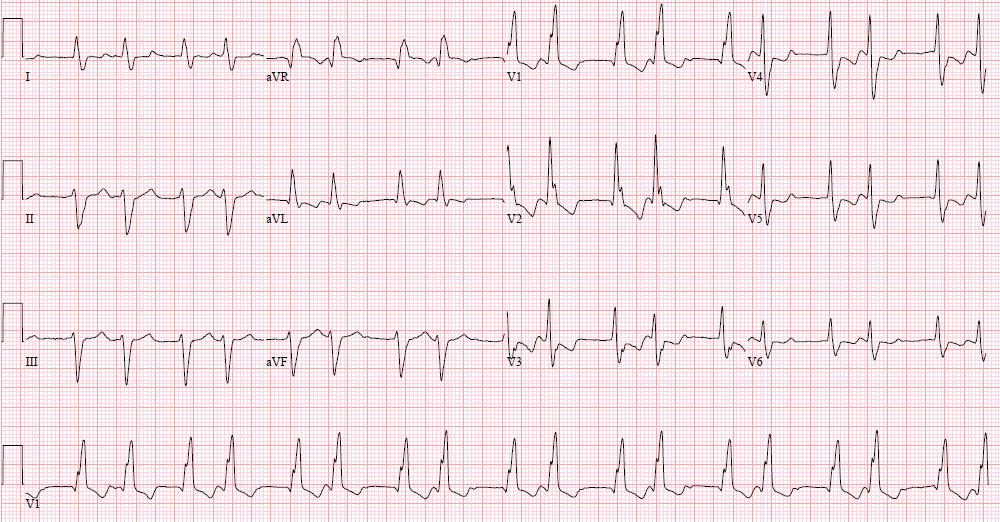 11-April-2015 A AV Green (P waves), Red (QRS s), Blue (PR intervals) V ECG
