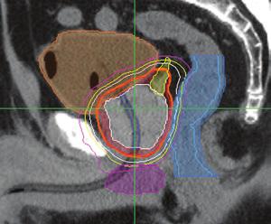 Clinical studies radiotherapy (SBRT) with end-to-end sub-millimeter accuracy.