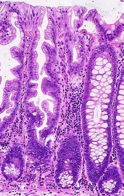 I. Sessile Serrated Neoplasia Pathway (Right) Proximal