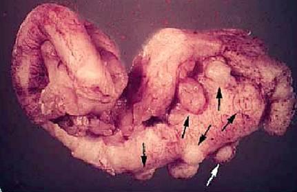 Appendix diverticulitis 90% of diverticuli