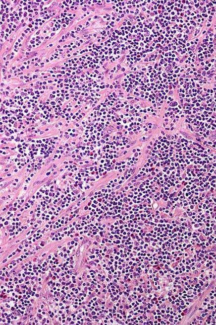 lymphoma MLH1 T-cell