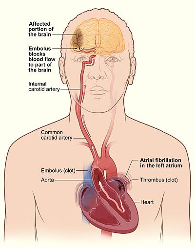 Stroke Embolic Strokes are caused by clot or debris going to the vessels of the brain.