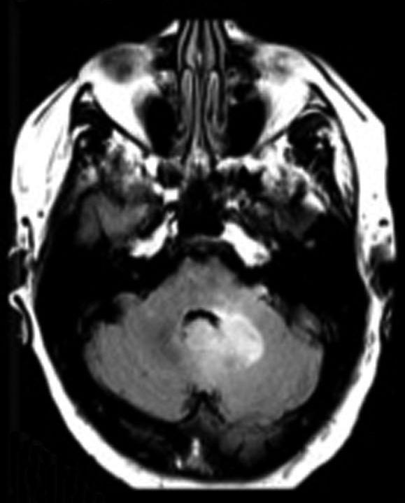 2) and patient #10 (Fig. 3) were diagnosed with grade III astrocytoma and received 12 cycles of temozolomide, while patient #1 with grade IV GBM declined chemotherapy (Fig. 4).