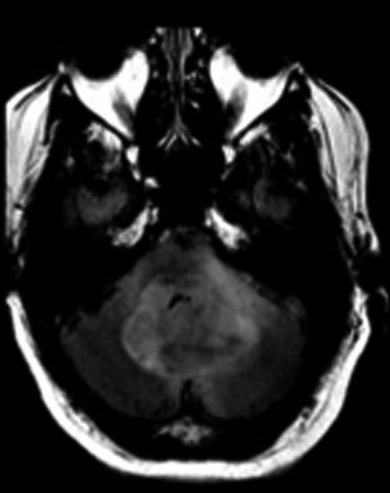 Progressive enlargement of the secondary lesion could progress to obstructive hydrocephalus (Fig. 2F).
