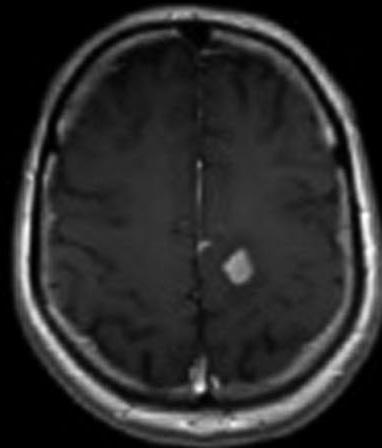 These patients had different initial WHO grades of glial tumors, in different initial