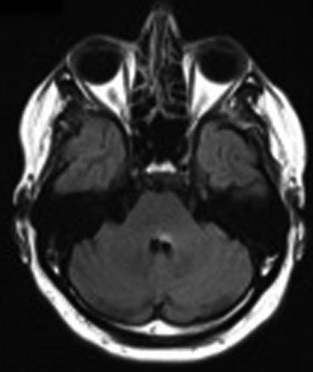 hemisphere or cerebellar vermis.