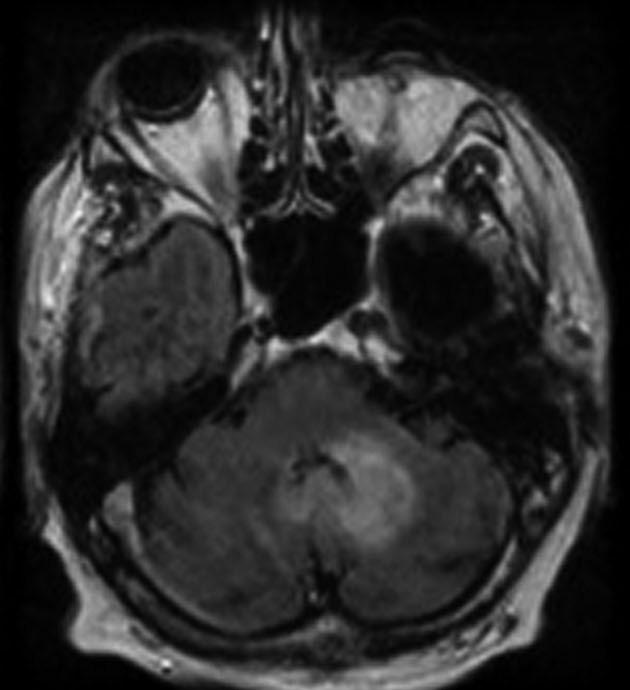 After two years, the patient develops a new left cerebellar FLAIR-hyperintense lesion (B), histologically grade II astrocytoma.