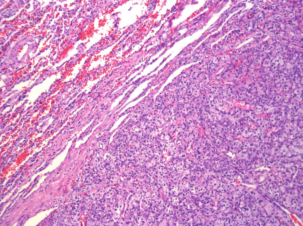 2 Figure 1: Well-demarcated but not encapsulated tumor with focal involvement of the adjacent alveolar air spaces (hematoxylin-eosin,