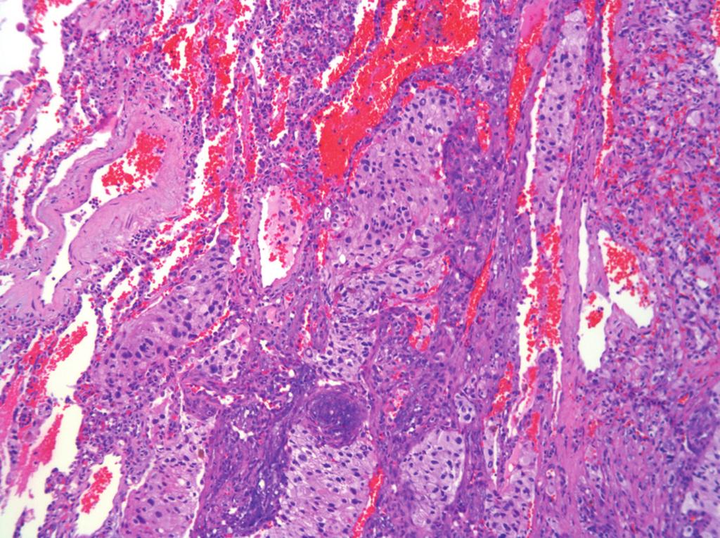 (c) (d) Figure 2: Variable histological features: prominent capillary network, pleomorphic nuclei (b and c), solid tumor nodules (c),