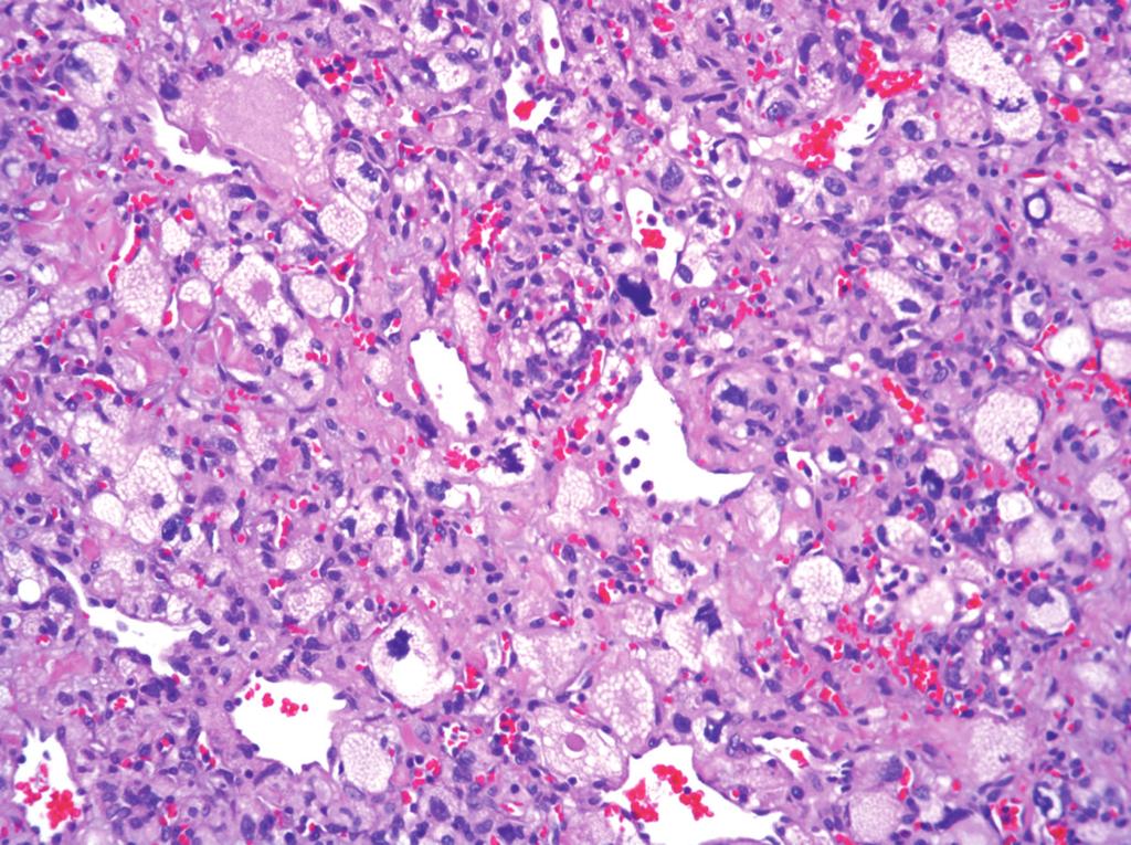 Microscopically, at low magnification, the tumors were unencapsulated (Figures 1 and 1) but well circumscribed (Figure 1) with a few