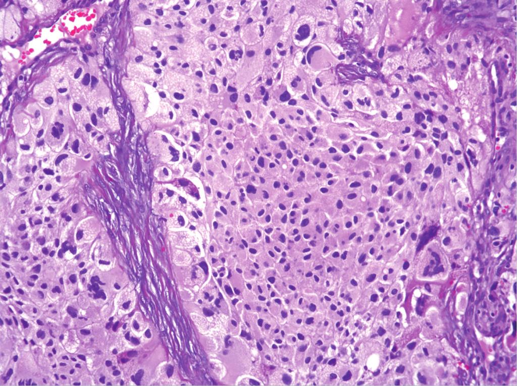 Both tumors contained a prominent capillary network (Figures 2 and 2) with intervening stromal cells exhibiting varying degrees of