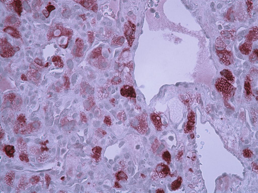3 (c) (d) Figure 3: Positive immunoreactivity is characteristic of hemangioblastoma with the following markers: inhibin-a, neuron specific enolase (NSE), (c) S-100, and (d) CD34 (original