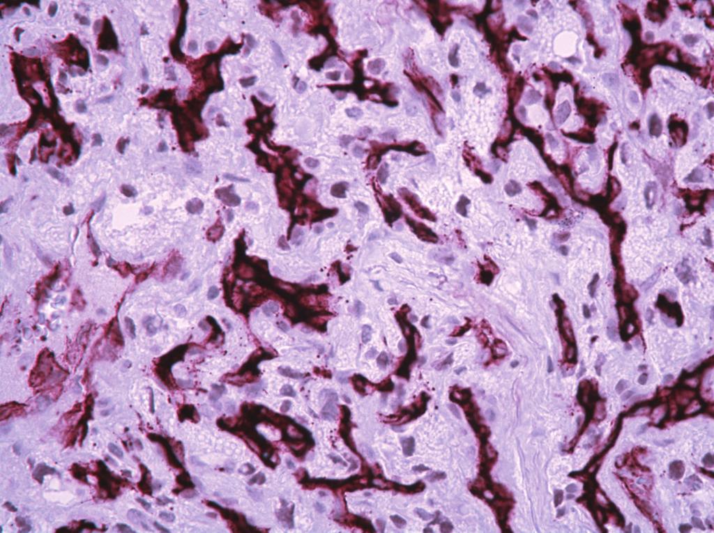 Based on this clinical information and histological features of the tumor described above further immunohistochemistry studies were undertaken to investigate the possibility of metastatic brain tumor