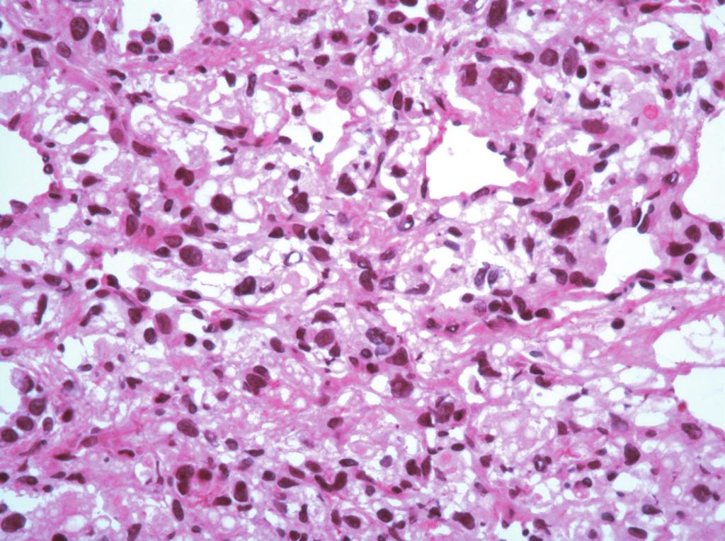 4 Table 1: Results of immunohistochemistry studies on pulmonary hemangioblastoma.