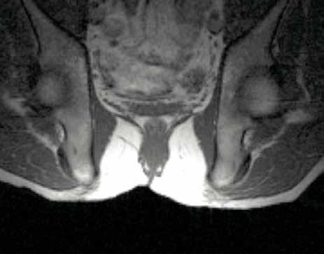 Reserch Summry MRI Deep Tissue Deformtion Off Loding Wheelchir Cushion provides est cse reduction in tissue deformtion s indicted y MRI Air Jv ft muscle Authors: Evn Cll MS, CSM Thoms Hetzel PT, ATP,
