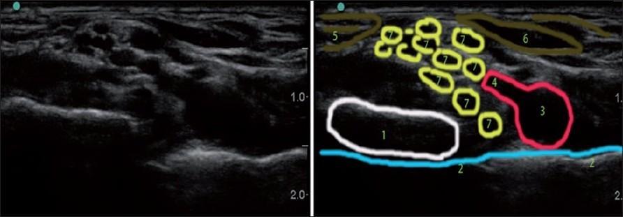 Ultrasound-guided Peripheral Nerve