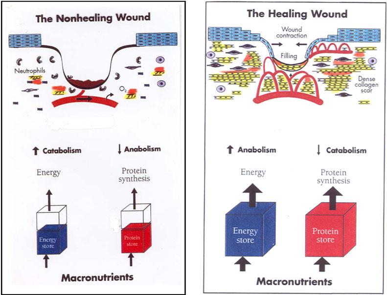 eplasty VOLUME 9 Figure 1. Balance between adequacy of macronutrients and net anabolism and catabolism and its impact on wound healing. amino acids, at the expense of the host LBM.