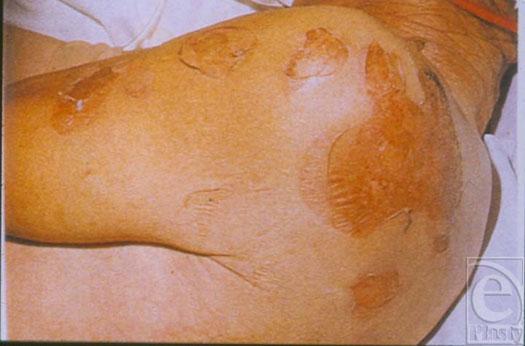 DEMLING Figure 5. Lean mass loss 25% the total: thinning of skin with loss of collagen as LBM decreases. Figure 6.
