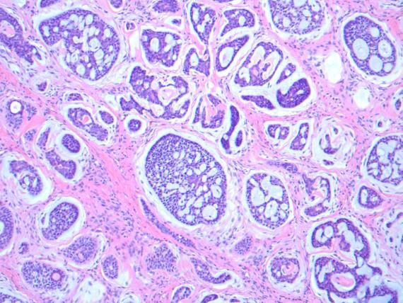 Adenoid Cystic Carcinoma Histology Tubular, cribriform,