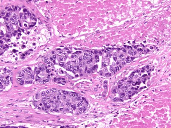 Adenoid cystic carcinoma with high grade transformation 46 Adenoid cystic