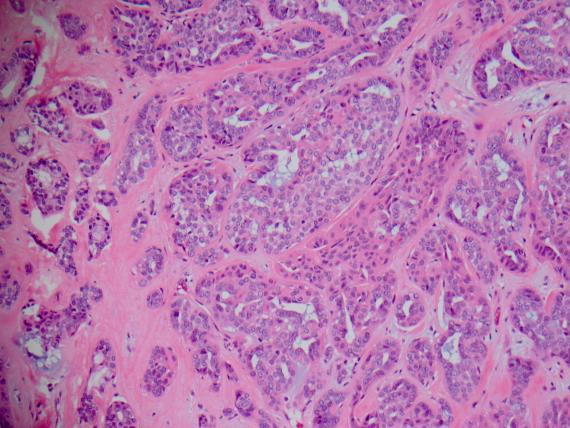 Polymorphous Low Grade Histology Mixed growth patterns Open nuclei, bland Perineural and stromal invasion 55 Polymorphous Low Grade