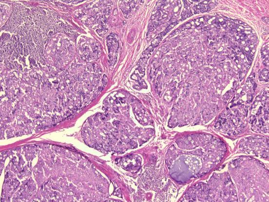 Shifty Acquaintances 61 Acinic Cell Carcinoma Histology--variable Serous Papillary-cystic Tubulolobular Special