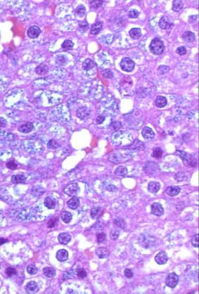 Acinic cell carcinoma, H&E PAS after diastase 64 Zymogen