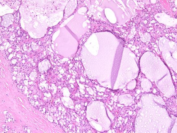 Mammary Analogue Secretory Carcinoma Clinical Rare tumor, but not well described yet Mean age 45 Males > Females 69% in major salivary glands 22% with nodal metastasis 92 month disease free survival