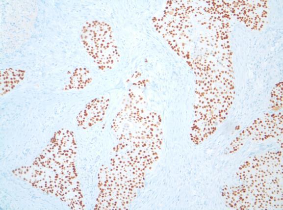 Oncocytic Mucoepidermoid Carcinoma, p63 Oncocytic MEC