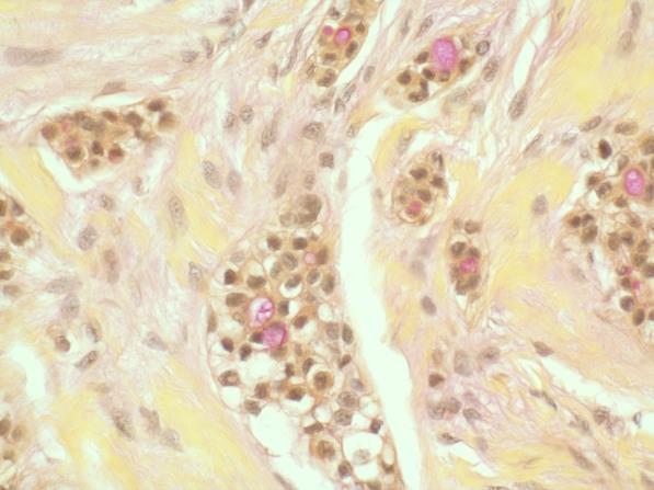 Clear cell Mucoepidermoid Carcinoma,