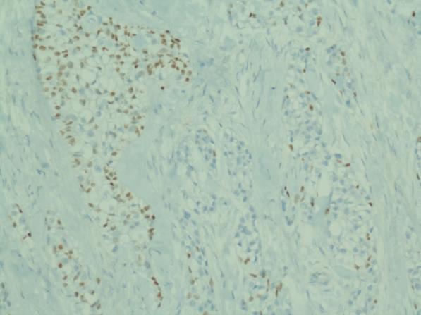 Clear cell (hyalinizing) carcinoma