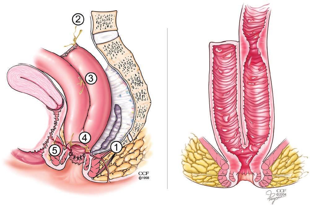 534 HOLUBAR: COMPLICATIONS OF IPAA FOR ULCERATIVE COLITIS FIGURE 2. Illustration of common IPAA complications.