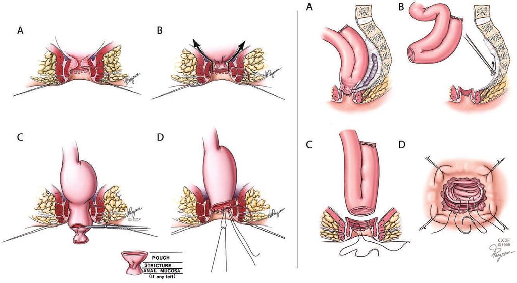 Right panel illustrates, from top to bottom, afferent limb stricture, pouchitis with aphthous ulcerations, and a pouch-anal anastomosis stricture. CCF 2018.