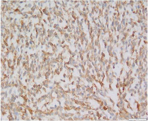 IHC: CD117 staining Diagnosis High Risk Gastric GIST IHC: SDHB loss Diagnosis High Risk SDH Deficient