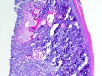 dyad Gastric GIST+ Paraganglioma Germline SDHx mutation
