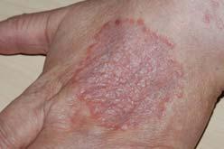 GRANULOMA ANNULARE Generally children and young adults but, diseases don t read the