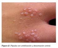 PERFORATING GRANULOMA ANNULARE Superficial small papules Hands