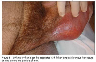 68 YEAR OLD MALE 1. Tinea 2. Psoriasis 3. Lichen simplex 1. Seborrheic dermatitis 2. Lichen simplex 3. Scabies 1. Tinea 2. Scabies 3. Psoriasis 4.
