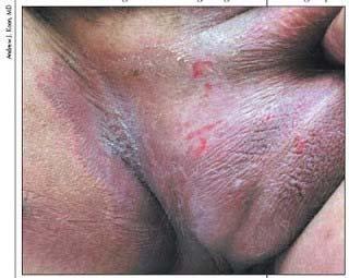 68 YEAR OLD MALE 1. Tinea 2. Psoriasis 3. Lichen simplex 1. Seborrheic dermatitis 2.