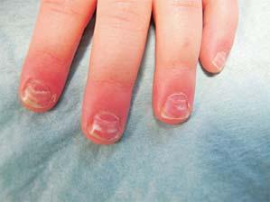 CLICKERS ONYCHOMADESIS Proximal, complete separation of the nail plate from nail bed Results from full, but temporary, arrest of nail growth