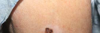 HALO NEVUS Central lesion characteristics and symmetry of halo may determine decision tree 1.