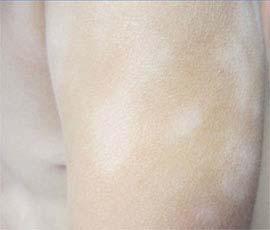 hypopigmented -- caused by transient and mild dermal inflammation TREATMENT emollient moisturizers -- mild
