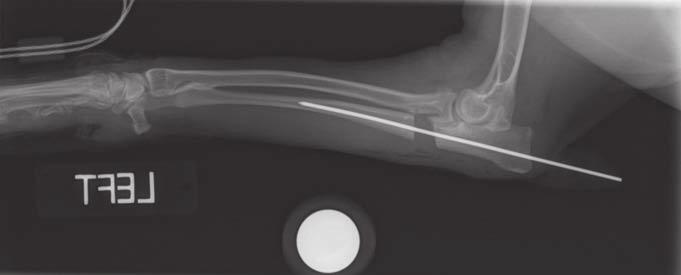 A Figure 11. Treatment of elbow incongruity generally involves corrective osteotomy. B Figure 10. (A) A radiograph showing an ostectomy before the intramedullary pin has been cut down.