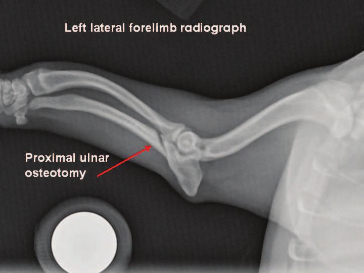 Premature closure of the distal ulnar or radial growth plates is not amenable to medical management; thus, early surgical intervention to restore congruity and alignment in the elbow joint is