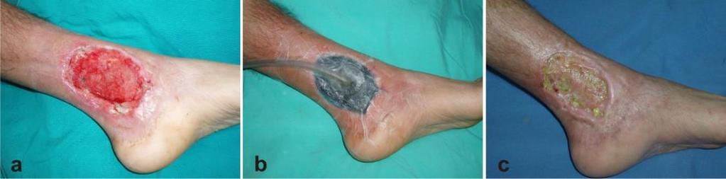 Skin Grafts! New skin can t heal itself if an injury destroys the s. basale.